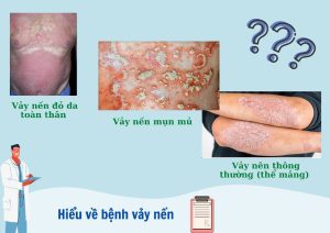 benh vay nen can kieng nhung gi benh vay nen co chua duoc khong 2248