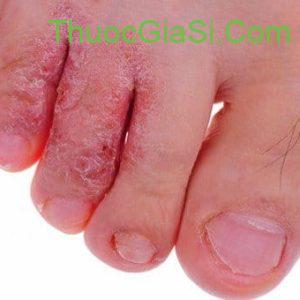 Ciclopirox 8% 10ml điều trị nấm móng tay, nấm móng chân 6 ciclopirox gel 0 77 dieu tri nam da hac lao lang ben viem da tiet ba nam candida 1689