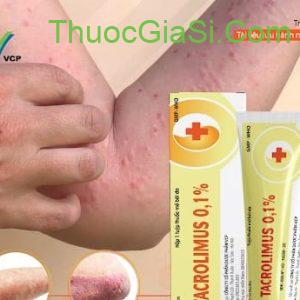 Tacrolimus 0.1% VCP 15g - Điều trị viêm da cơ địa, dị ứng